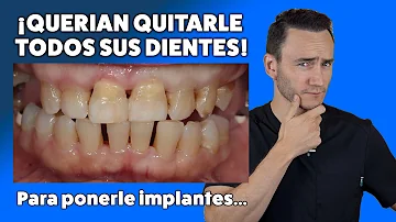 ¿Cuántos implantes necesita para sustituir todos sus dientes?