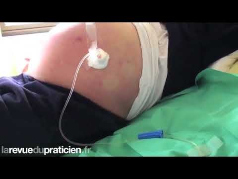 Vidéo: Accumulation De Liquide Dans L'abdomen Des Furets