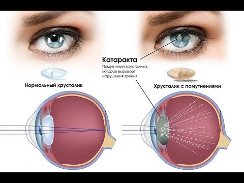 КАК СПРАВИТЬСЯ С КАТАРАКТОЙ.  Кирилл Вершилов Аврора