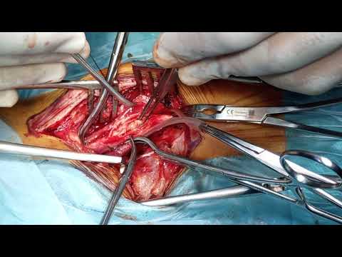 Vidéo: Artère Carotide - Chirurgie, Maladies, Structure
