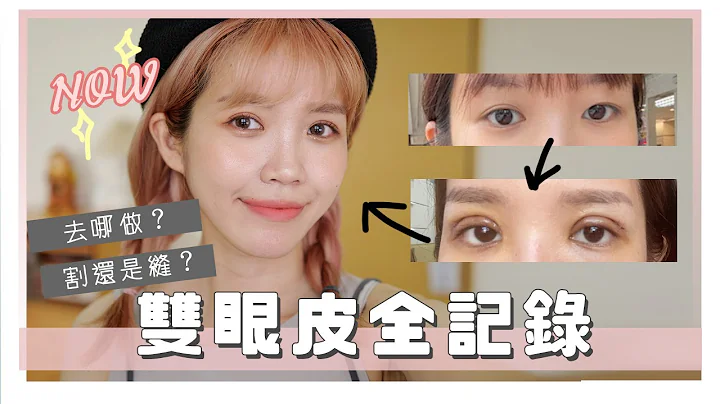 花7萬整形！雙眼皮+提眼肌手術全記錄！｜double eyelid surgery｜居妮Ginny Daily♥ - 天天要聞