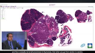 Pathology Insights: Basics of Thymic Pathology with Sanjay Mukhopadhyay, MD