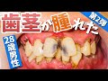 歯茎が腫れた😭28歳男性🦷【Tartar removal 】A 28-year-old man with swelling gums