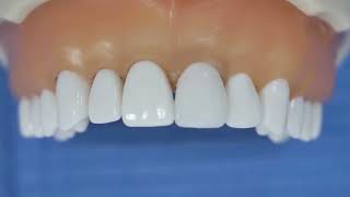 Variolink Esthetic LC | Cómo cementar una carilla