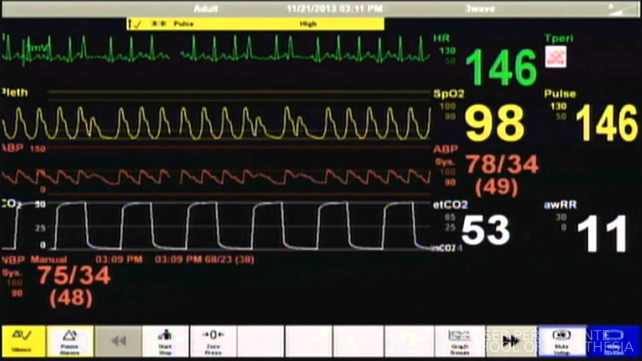 Cardiac Arrest   Patient Monitor