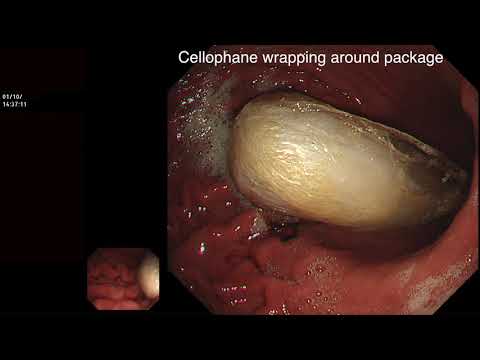 EXTRACTION OF DRUG PACKAGE FROM STOMACH