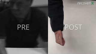 Before/After recoveriX - stroke - FARO - ST15
recoveriX is measuring EEG activity while a patient imagines a hand or foot movements. Once recoveriX detects a motor imagination, it triggers a functional electrical stimulation of the limb so that the limb performs a real movement. Here you can see the improvement in the hand movement of the stroke-affected hand.
Learn more about this treatment: https://recoverix.com/ Before/After recoveriX - stroke - FARO - ST15