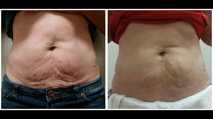 Firm Before & After Pics