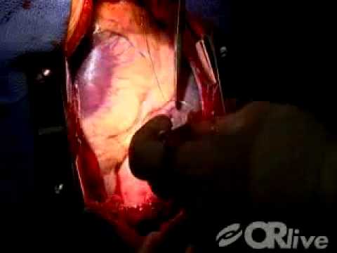 Mitral Valve Replacement for rheumatic mitral sten...