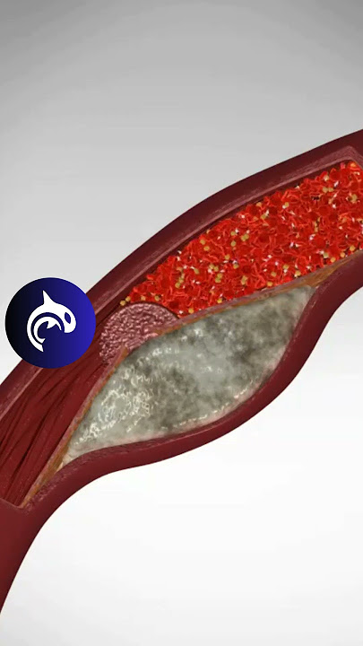 See what a Heart Attack looks like in your body - 3D Animation #heart #heartattack #hearthealth