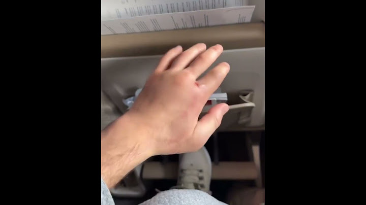 Umar's hand after fighting Merab at #UFC311 😳