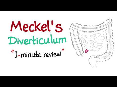 Meckel&rsquo;s Diverticulum (1-minute review)