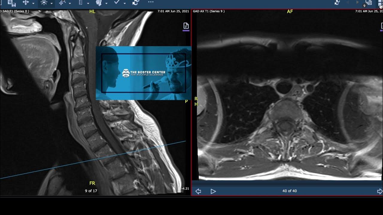Multiple Sclerosis MRI MS Lesions on Spine YouTube