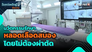 นวัตกรรมรักษาหลอดเลือดสมองโดยไม่ต้องผ่าตัด | ไทยประดิษฐ์คิดเก่ง