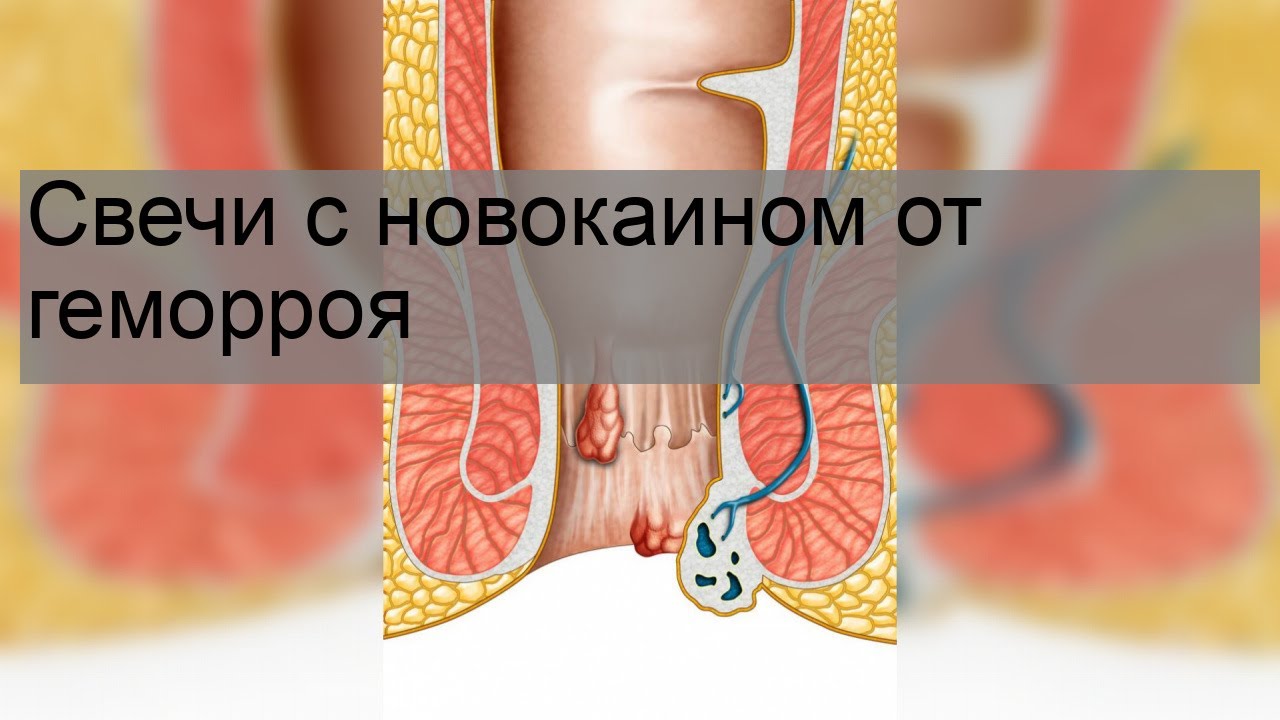 Свечи с новокаином от геморроя