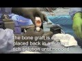 Osteochondral Transplant Knee Surgery