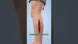 How Stitches Actually Work