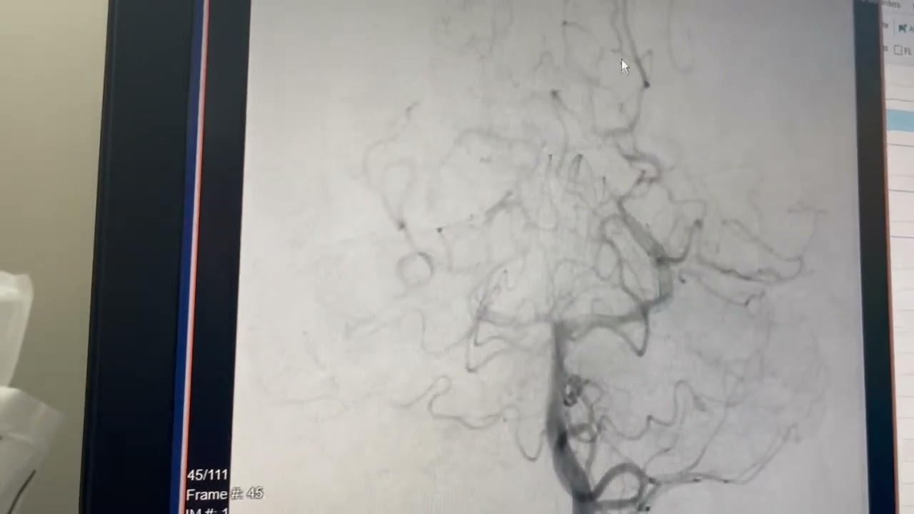 BRAIN AVM Three Years After Gamma Knife Radiation