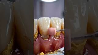 Extreme Dental Scaling ASMR 🦷 Deep Cleaning Simulation #oddlysatisfying