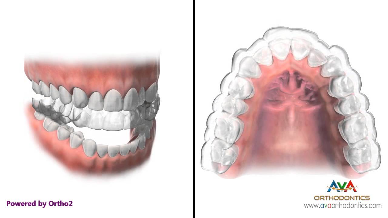 Invisalign cost