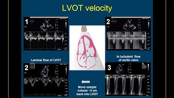 Guideline-based Webinar on the Echo Assessment of Aortic Valve Stenosis