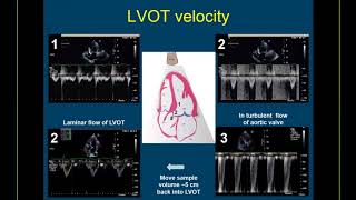 Guidelinebased Webinar on the Echo Assessment of Aortic Valve Stenosis