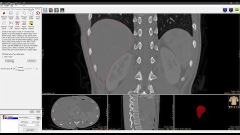 Analyze 15.0 - Segment: Spline Trace