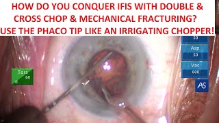 TBWTDCS #182: Conquer IFIS with Mechanical Fracturing? Use the Phaco Tip Like an Irrigating Chopper!