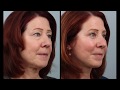 Day By Day Weekend (Mini) Facelift & Blepharoplasty Recovery