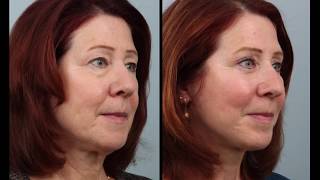 Day By Day Weekend (Mini) Facelift & Blepharoplasty Recovery