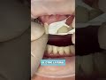 ¿Cómo se ponen las CARILLAS DENTALES? 🤔🦷 Antes y después #shorts #carillasdentales #dentist