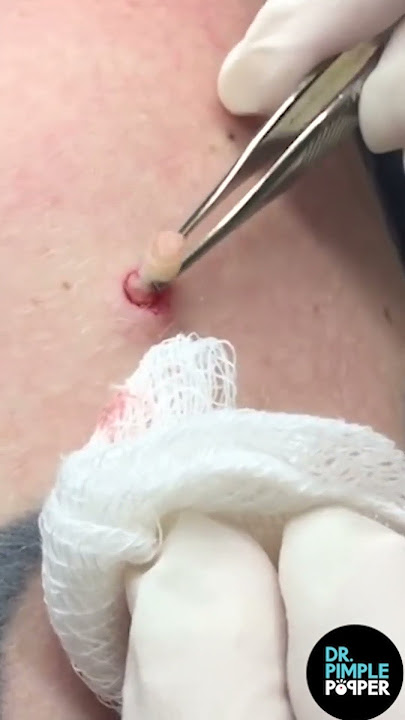 A Hard Pops Medley by Dr. Pimple Popper