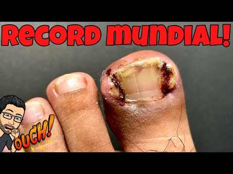 LA UÑA ENCARNADA MAS GRANDE DEL MUNDO!!