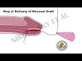 Minimally Invasive Method for Distal Urethral Reconstruction- Patient Information