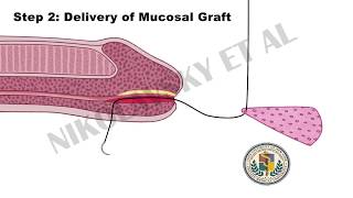 Minimally Invasive Method for Distal Urethral Reconstruction- Patient Information