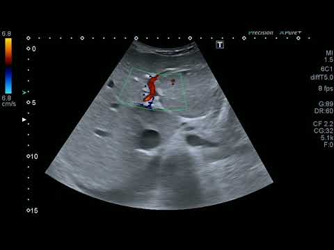 Ultrasound video showing bidirectional portal vein flow in portal hypertension