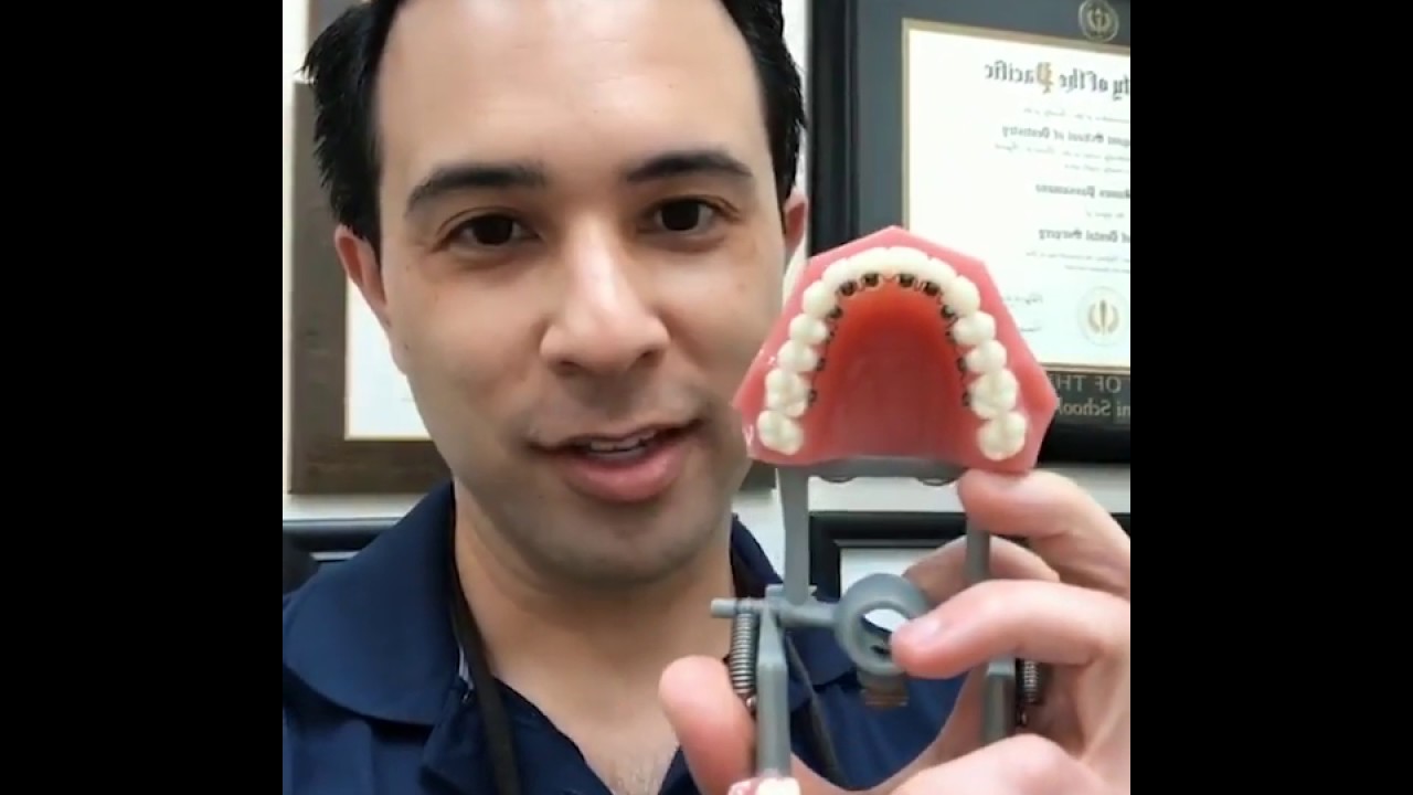 Lingual Braces Tutorial InBrace Tutorial Dr. Robert Passamano