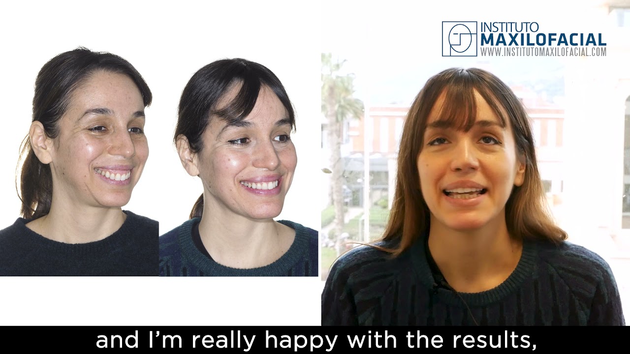 Case # 77: Taide - Class 2, gummy smile,  overbite, biretrusion