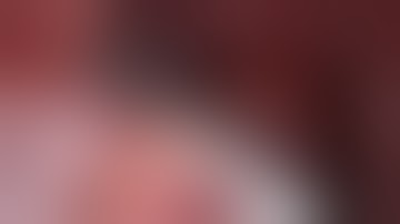 Robotic Sigmoidectomy with natural orfice extraction and then a 29EEA