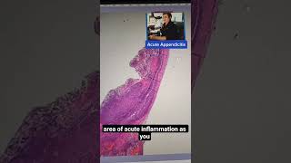 Acute Appendicitis