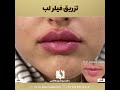 تزریق فیلر لب در شیراز توسط دکتر مهسا پور هاشمی
