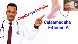 Vitamin A Deficiency Calaamadaha Lagu Garto