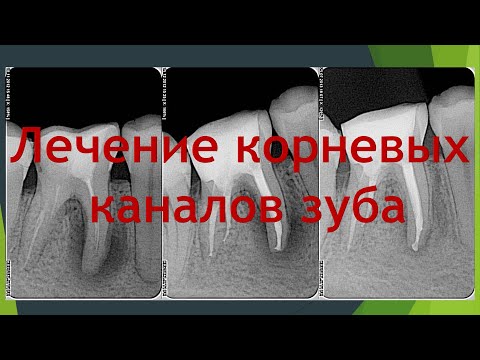 Секреты Стоматологии - Глава 3. Лечение Каналов
