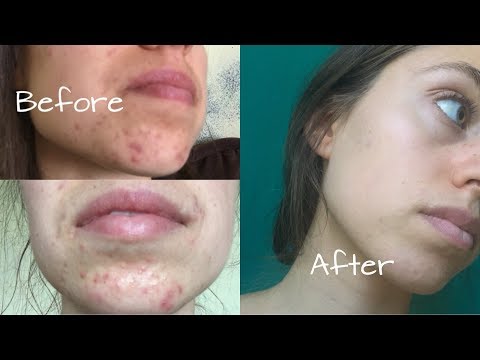 HOW I HEALED MY HORMONAL ACNE | My Acne Story