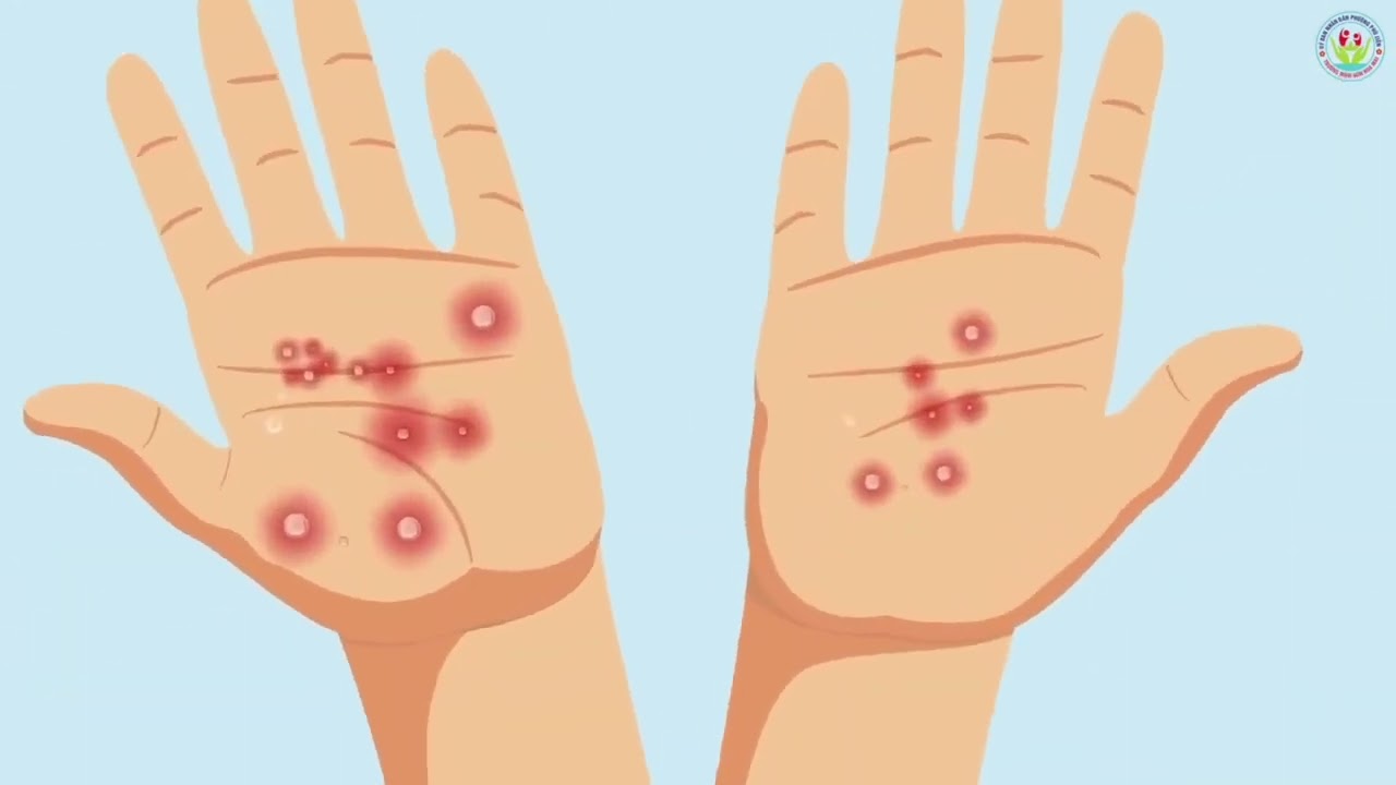 CHUNG TAY PHÒNG CHỐNG BỆNH TAY CHÂN MIỆNG