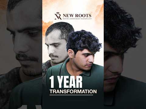 Hair Transplant in Lucknow | Natural Hairline | 2500 Grafts | Cost and Best Results #hair #shorts