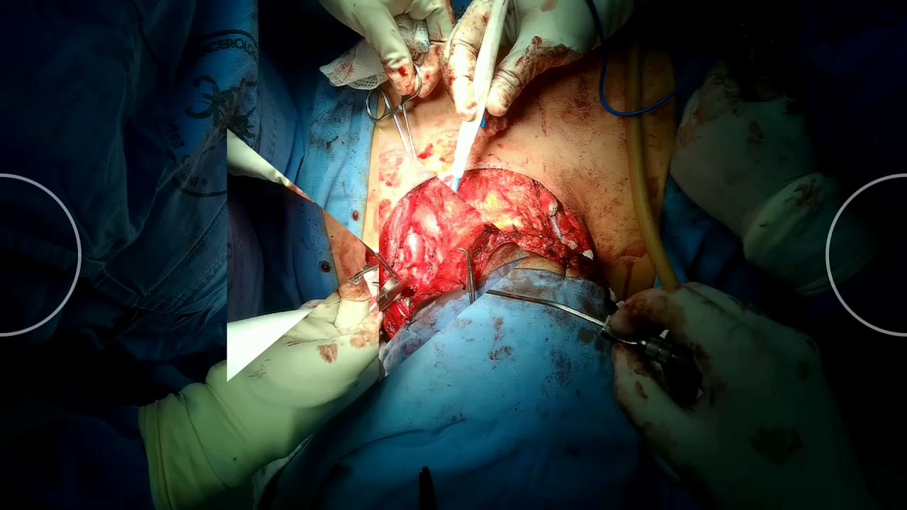 Tiroidectomía total con disección radical bilateral de cuello.