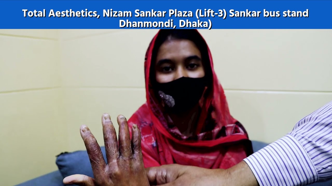 Post Burn Contracture of the Fingers with Syndactyl। Dr Sharif Plastic Surgeon