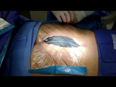 How to apply WoundVac -a miracle in management of infected and open wound -