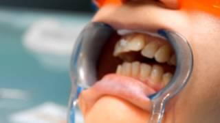 Установка брекетов(Установка керамических брекетов в стоматологической клинике 